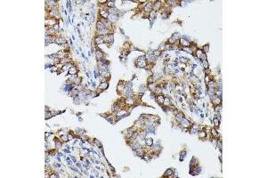 Immunohistochemistry of paraffin-embedded human lung cancer using MTIF2 antibody (ABIN7268591) at dilution of 1:100 (40x lens). (MTIF2 anticorps  (AA 428-727))