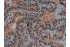 Detection of uPAR in Human Thyroid cancer Tissue using Polyclonal Antibody to Plasminogen Activator, Urokinase Receptor (uPAR)