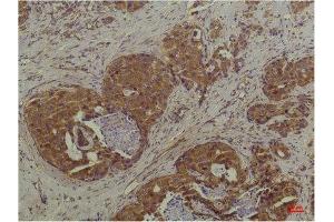 Immunohistochemistry (IHC) analysis of paraffin-embedded Human Breast Carcinoma using P44/42 MAPK (ERK1/2) Mouse Monoclonal Antibody diluted at 1:200. (ERK1/2 anticorps)