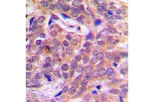 Immunohistochemical analysis of Beta-catenin (pS37) staining in human breast cancer formalin fixed paraffin embedded tissue section.