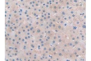 Detection of TLR3 in Human Liver cancer Tissue using Polyclonal Antibody to Toll Like Receptor 3 (TLR3)