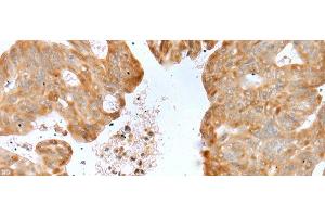Immunohistochemistry of paraffin-embedded Human gastric cancer tissue using P2RY4 Polyclonal Antibody at dilution of 1:40(x200) (P2RY4 anticorps)