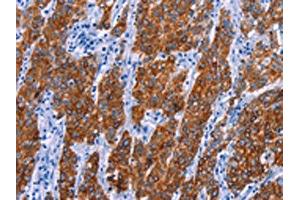 The image on the left is immunohistochemistry of paraffin-embedded Human gastic cancer tissue using ABIN7130460(NR4A2 Antibody) at dilution 1/20, on the right is treated with fusion protein. (NR4A2 anticorps)