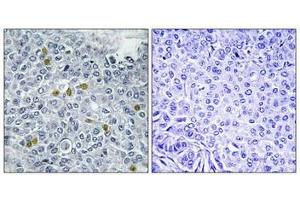 Immunohistochemistry analysis of paraffin-embedded human breast carcinoma tissue using TOP2A (Phospho-Ser1106) antibody.