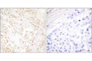 Immunohistochemistry analysis of paraffin-embedded human breast carcinoma tissue, using XRCC6 Antibody. (RCC6 (AA 554-603) anticorps)