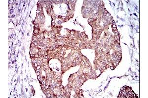 Immunohistochemical analysis of paraffin-embedded rectum cancer tissues using PDE1B mouse mAb with DAB staining.