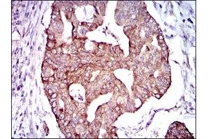 Immunohistochemical analysis of paraffin-embedded rectum cancer tissues using PDE1B mouse mAb with DAB staining. (PDE1B anticorps  (AA 370-536))