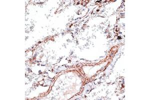 Immunohistochemistry of paraffin-embedded human lung using Vimentin antibody (ABIN3016291, ABIN3016292, ABIN3016293 and ABIN6219693) at dilution of 1:100 (40x lens). (Vimentin anticorps  (AA 1-200))