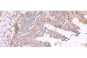 Immunohistochemistry of paraffin-embedded Human colorectal cancer tissue using ZSWIM1 Polyclonal Antibody at dilution of 1:55(x200) (ZSWIM1 anticorps)