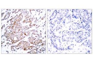 Immunohistochemical analysis of paraffin-embedded human breast carcinoma tissue using Myc (phospho-Thr58) antibody (E011034). (c-MYC anticorps  (pThr58))