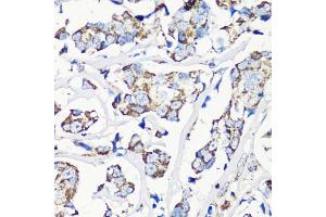 Immunohistochemistry of paraffin-embedded human breast cancer using MMP16 antibody (ABIN6132356, ABIN6143906, ABIN6143907 and ABIN6214654) at dilution of 1:100 (40x lens).