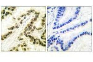 Immunohistochemical analysis of paraffin-embedded human breast carcinoma tissue using AP-2 antibody.