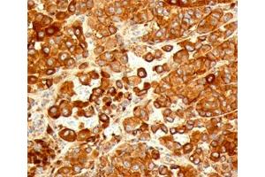IHC testing of human melanoma stained with CD63 antibody (NKI/C3). (CD63 anticorps)