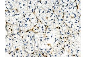 Phospho-Histone H3 (Ser28) Antibody at 1/100 staining Human kidney cancer by IHC-P.