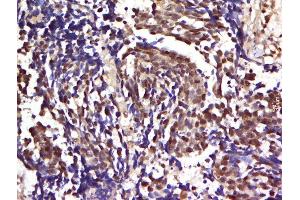 Paraformaldehyde-fixed, paraffin embedded human lung carcinoma tissue, Antigen retrieval by boiling in sodium citrate buffer(pH6) for 15min, Block endogenous peroxidase by 3% hydrogen peroxide for 30 minutes, Blocking buffer (normal goat serum) at 37°C for 20min, Antibody incubation with Rabbit Anti-CBL2 (Tyr700) Polyclonal Antibody, Unconjugated  at 1:500 overnight at 4°C, followed by a conjugated secondary and DAB staining