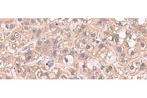 Immunohistochemistry of paraffin-embedded Human liver cancer tissue using SARS Polyclonal Antibody at dilution of 1:65(x200)