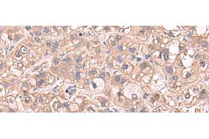 Immunohistochemistry of paraffin-embedded Human liver cancer tissue using SARS Polyclonal Antibody at dilution of 1:65(x200) (Seryl-tRNA Synthetase (SARS) anticorps)