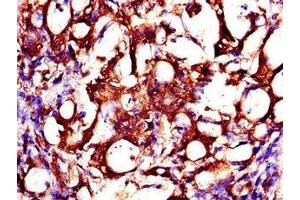 Immunohistochemistry of paraffin-embedded human gastric cancer using ABIN7146178 at dilution of 1:100 (ZMPSTE24 anticorps  (AA 217-347))