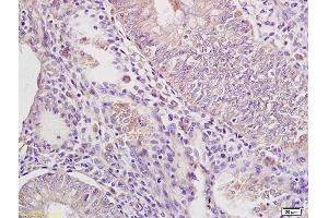 Formalin-fixed and paraffin embedded human endometrium carcinoma labeled with Rabbit Anti IRAK4 Polyclonal Antibody, Unconjugated (ABIN740310) at 1:200 followed by conjugation to the secondary antibody and DAB staining (IRAK4 anticorps  (AA 21-120))
