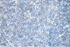 Immunohistochemistry was performed on paraffin-embedded human lymphoma using cytokine receptor like factor 3 antibody (ABIN7798262), 1:200). (CRLF3 anticorps)