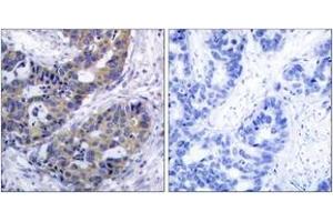Immunohistochemistry analysis of paraffin-embedded human breast carcinoma tissue, using IRS-1 (Ab-312) Antibody.