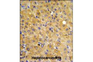 DLG7 Antibody IHC analysis in formalin fixed and paraffin embedded hepatocarcinoma followed by peroxidase conjugation of the secondary antibody and DAB staining. (DLGAP5 anticorps  (AA 228-258))