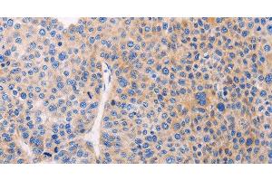 Immunohistochemistry of paraffin-embedded Human liver cancer using ADCY1 Polyclonal Antibody at dilution of 1:60 (ADCY1 anticorps)