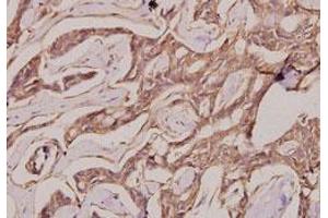 Immunohistochemical analysis of paraffin-embedded human breast cancer tissue using IgG1 polyclonal antibody . (Lapin anti-Humain IgG1 (AA 211-260) Anticorps)
