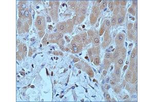 Immunohistochemical staining (Formalin-fixed paraffin-embedded sections) of human hepatocellular carcinoma with DNMT1 monoclonal antibody, clone 60B1220. (DNMT1 anticorps  (AA 637-650))