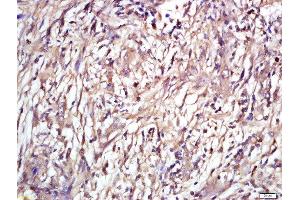 Formalin-fixed and paraffin embedded human laryngeal tissue labeled with Rabbit Anti-ENT2 Polyclonal Antibody, Unconjugated (ABIN2559658) at 1:200 followed by conjugation to the secondary antibody and DAB staining (SLC29A2 anticorps  (AA 221-320))