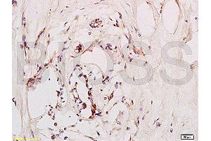 Formalin-fixed and paraffin embedded human breast carcinoma labeled with Anti-CD184/CXCR4 Polyclonal Antibody (ABIN730888), Unconjugated at 1:200, followed by conjugation to the secondary antibody and DAB staining
