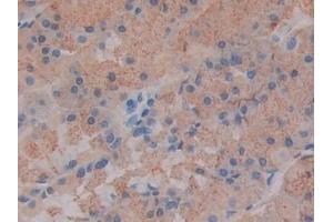 Detection of Slit1 in Human Stomach cancer Tissue using Polyclonal Antibody to Slit Homolog 1 (Slit1)