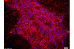 Formalin-fixed and paraffin embedded human laryngocarcinoma labeled with Anti Dyrk1B Polyclonal Antibody, Unconjugated (ABIN716501) at 1:200 followed by conjugation to the secondary antibody Goat Anti-Rabbit IgG, Cy3 conjugated used at 1:200 dilution for 40 minutes at 37°C and DAPI staining