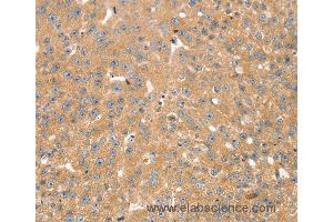 Immunohistochemistry of Human breast cancer using SNX2 Polyclonal Antibody at dilution of 1:40 (Sorting Nexin 2 anticorps)