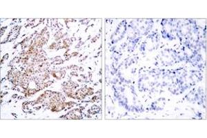 Immunohistochemistry analysis of paraffin-embedded human breast carcinoma, using Myc (Phospho-Thr58) Antibody. (c-MYC anticorps  (pThr58))