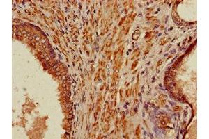 Immunohistochemistry of paraffin-embedded human prostate cancer using ABIN7165984 at dilution of 1:100 (PIH1D3 anticorps  (AA 1-214))