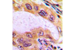 Immunohistochemical analysis of B4GALT3 staining in human liver cancer formalin fixed paraffin embedded tissue section.
