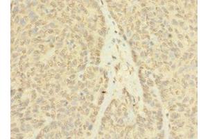 Immunohistochemistry of paraffin-embedded human ovarian cancer using ABIN7144247 at dilution of 1:100