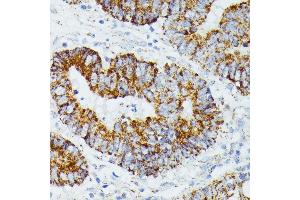 Immunohistochemistry of paraffin-embedded human colon carcinoma using ETHE1 antibody (ABIN6131616, ABIN6140319, ABIN6140320 and ABIN6214289) at dilution of 1:100 (40x lens).