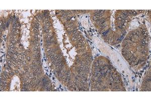Immunohistochemistry of paraffin-embedded Human colon cancer using CUL3 Polyclonal Antibody at dilution of 1:30 (Cullin 3 anticorps)