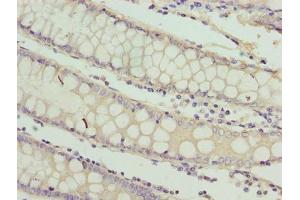 Immunohistochemistry of paraffin-embedded human colon cancer using ABIN7167326 at dilution of 1:100