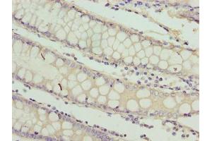 Immunohistochemistry of paraffin-embedded human colon cancer using ABIN7167326 at dilution of 1:100 (RAB3B anticorps  (AA 1-219))