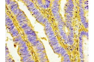 IHC image of ABIN7159833 diluted at 1:100 and staining in paraffin-embedded human colon cancer performed on a Leica BondTM system.