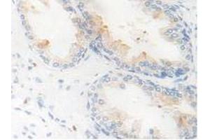 IHC-P analysis of Human Prostate Gland Tissue, with DAB staining. (Kallikrein 11 anticorps  (AA 39-282))