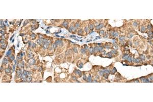 Immunohistochemistry of paraffin-embedded Human thyroid cancer tissue using BLNK Polyclonal Antibody at dilution of 1:40(x200) (B-Cell Linker anticorps)