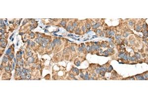 Immunohistochemistry of paraffin-embedded Human thyroid cancer tissue using BLNK Polyclonal Antibody at dilution of 1:40(x200)