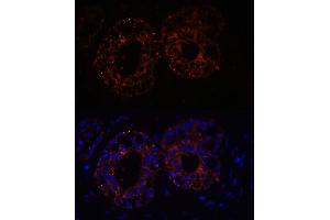Immunofluorescence analysis of Human mammary cancer cells using TNF-α antibody (ABIN3020862, ABIN3020863, ABIN3020864, ABIN1513617 and ABIN6213762) at dilution of 1:100. (TNF alpha anticorps  (AA 1-233))