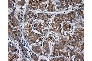 Immunohistochemical staining of paraffin-embedded Carcinoma of liver tissue using anti-KIAA1609 mouse monoclonal antibody. (KIAA1609 anticorps)