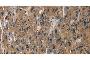 Immunohistochemistry of paraffin-embedded Human liver cancer using RAGE Polyclonal Antibody at dilution of 1:70 (RAGE anticorps)