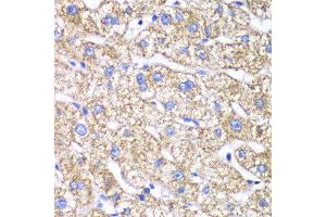Immunohistochemistry of paraffin-embedded human liver injury using DLST antibody at dilution of 1:100 (x40 lens).